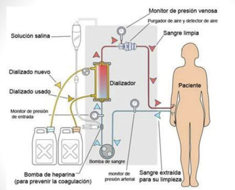 Hemodiálisis ALCER Alicante